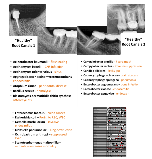 pathogens in root canals